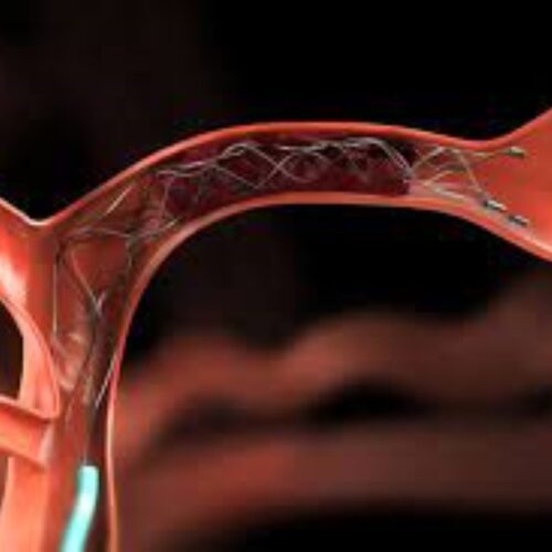 neuroendovascular Neuroendovascular