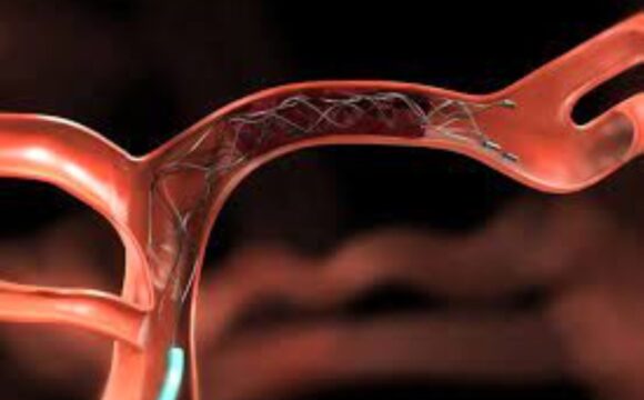 neuroendovascular Neuroendovascular