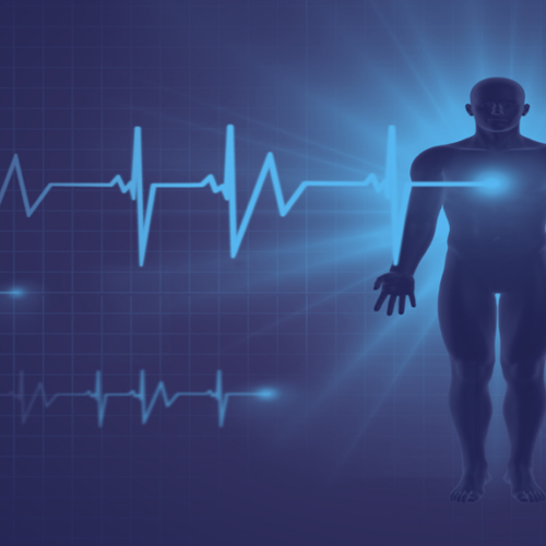 Sindrome de preexcitación Síndrome de preexcitación