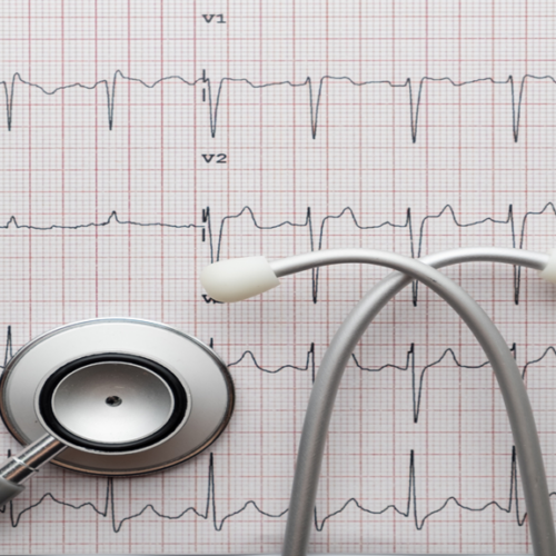 Síntomas bloque atrioventricular Síntomas del bloqueo atrioventricular