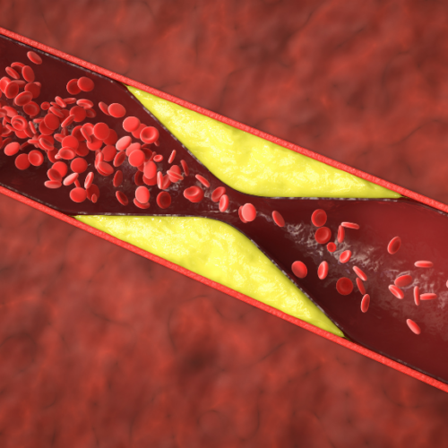 La cardiopatía isquémica y su tratamiento