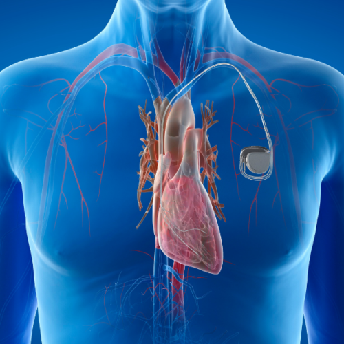 Marcapasos en el tratamiento del bloqueo atrioventricular