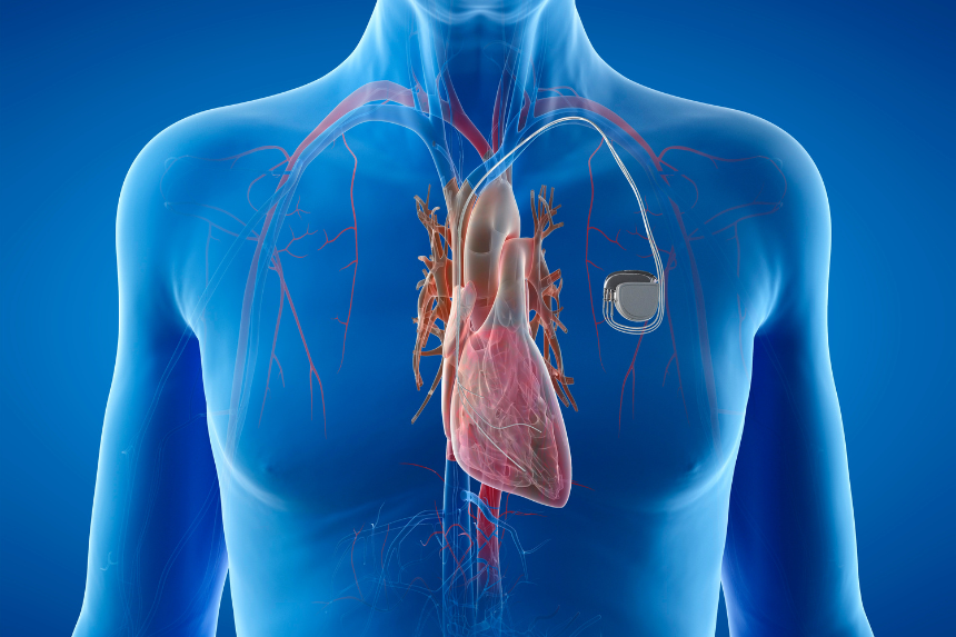 Marcapasos-2 Marcapasos en el tratamiento del bloqueo atrioventricular
