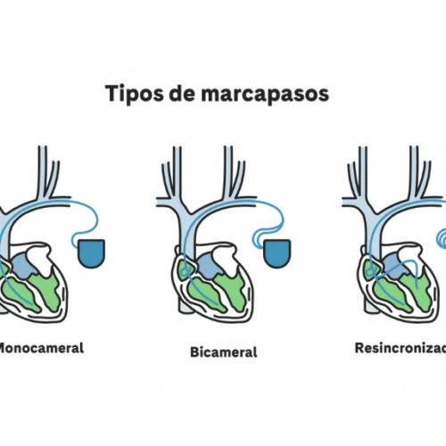 Tipos de marcapasos y su cuidado