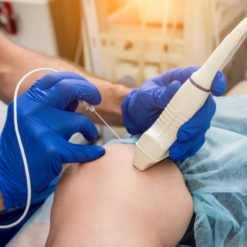 Ablación por radiofrecuencia